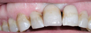Caso real de pérdida de un diente, imágenes del antes y el después.