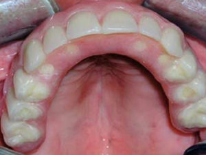 Tratamiento de un caso real de pérdida total de dientes