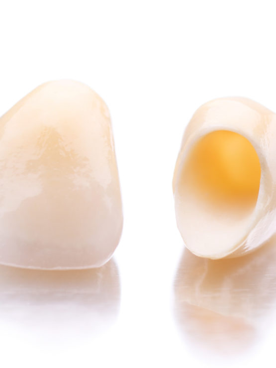 Coronas: prótesis dental sin metal - Dr Ferre