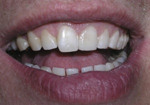 Resultado del tratamiento de una fractura dental
