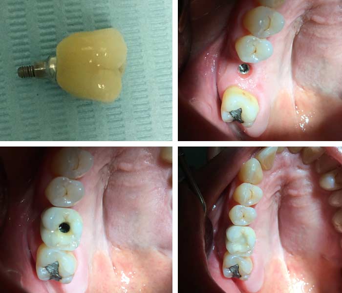 Caso real de pérdida de un diente y su tratamiento