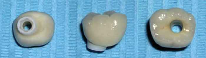 Caso real de pérdida de un diente, tratamiento de implantología y prótesis