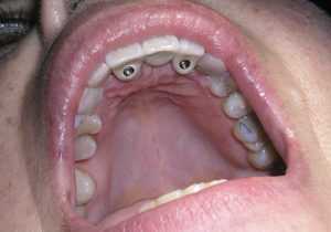 Tratamiento de un caso real de pérdida de varios dientes