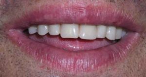 Caso real de carga inmediata en ausencia de dientes después del tratamiento